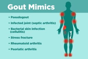 Gout Misdiagnosis