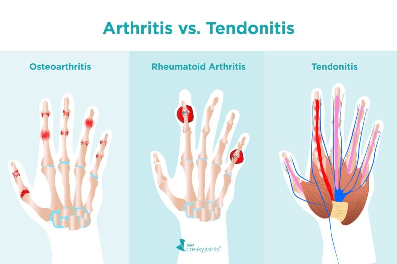 An illustration of three hands. On the left is a hand with red, inflamed joints. Above the hand is the word “Osteoarthritis.” In the middle is a hand with red, inflamed joints and red nodules. Above the hand is the word “Rheumatoid Arthritis.” On the right is a hand with red, inflamed tendons. Above the hand is the word “Tendonitis.”