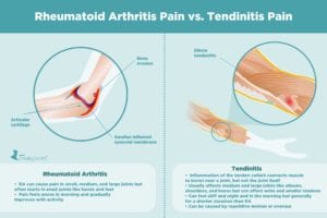 Rheumatoid Arthritis Pain vs. Tendinitis Pain
