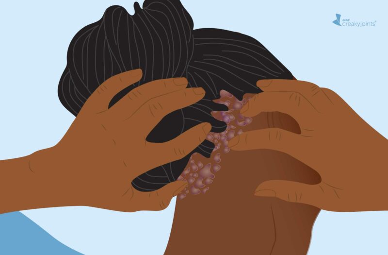 illustration of scalp psoriasis on Black hair