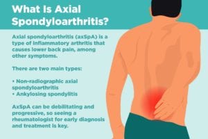 Axial Spondyloarthritis