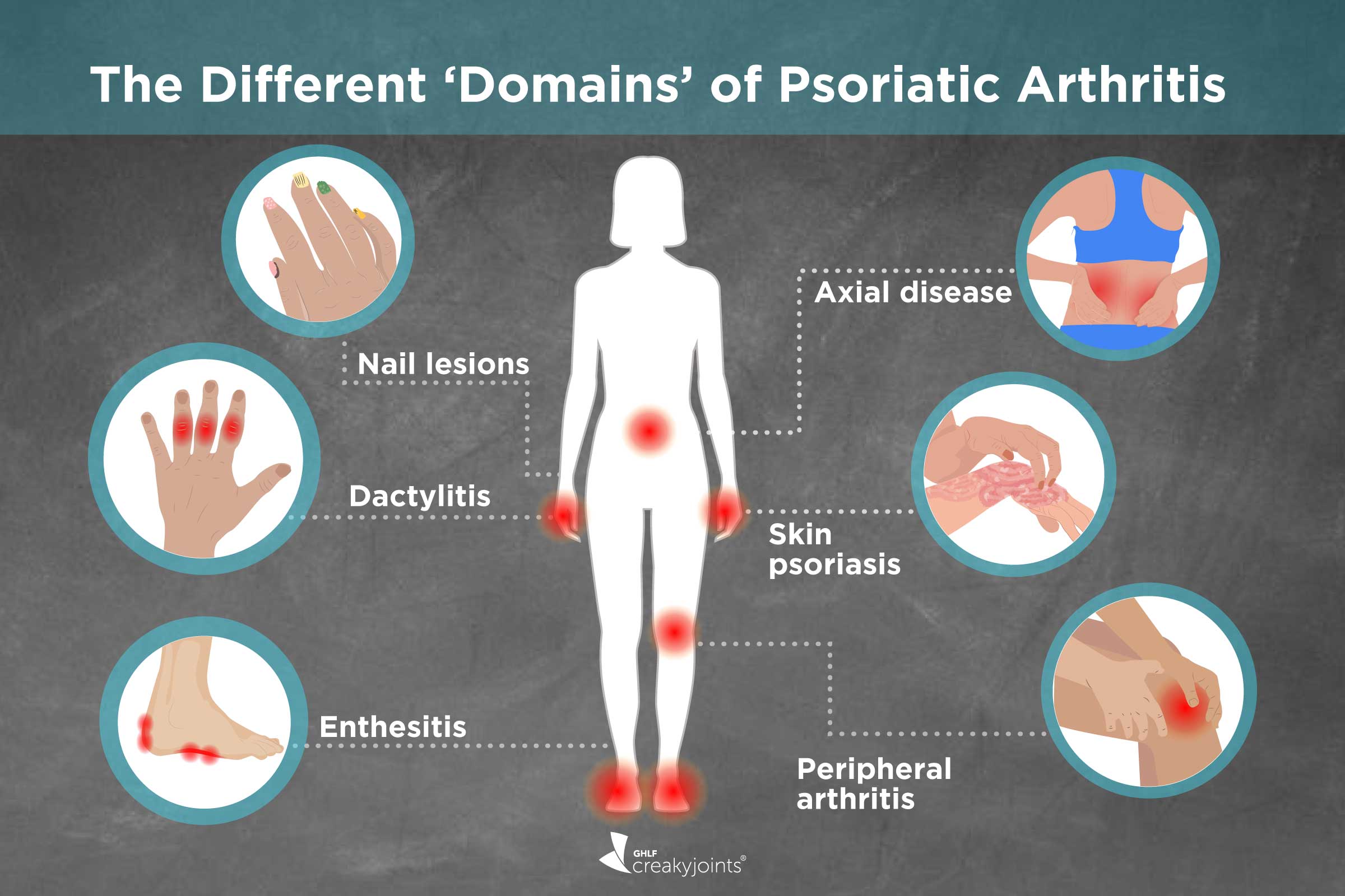 Types and Domains of Psoriatic Arthritis