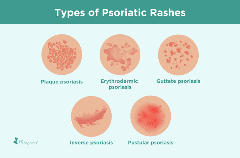 Psoriatic Arthritis Psoriasis Rashes