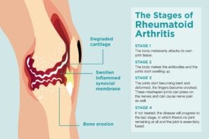 Stages of Rheumatoid Arthritis Progression