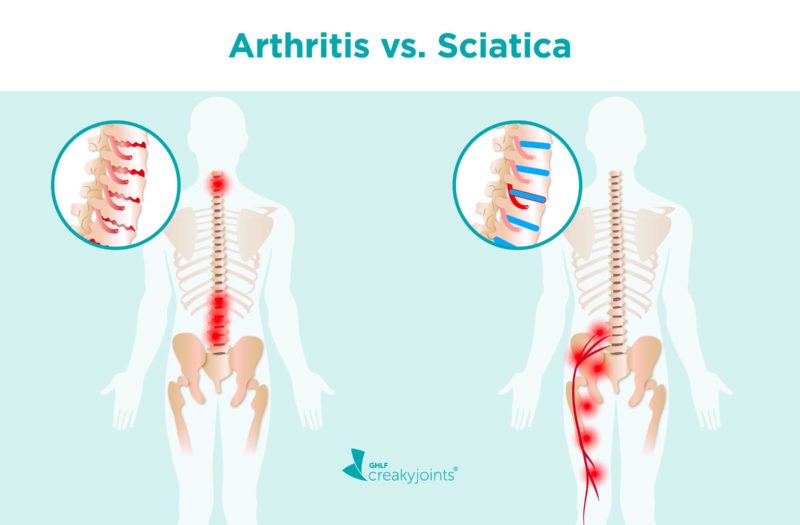 A side-by-side of two spines. On the top, the words “Arthritis vs. Sciatica.” The back/spine on the left is affected by arthritis. The image shows worn down cartilage (which is illustrated with red cracks on the cartilage), and inflammation to the spinal nerves and discs (which is illustrated with red pain spots). The back/spine on the right is affected by sciatica. The image shows inflammation where the sciatica nerve meets the piriformis muscle, and radiate down the rest of the nerve. There is also a herniated disc (a disc that is pushed further in than others).